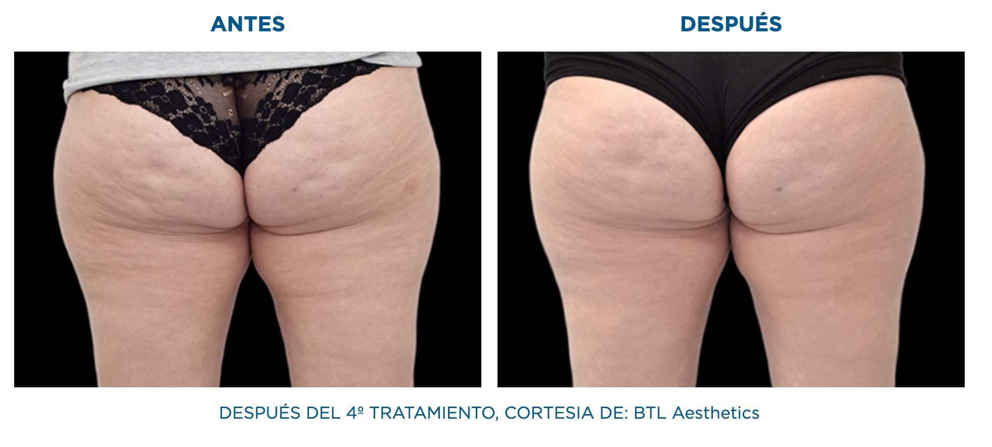 emtone antes y después