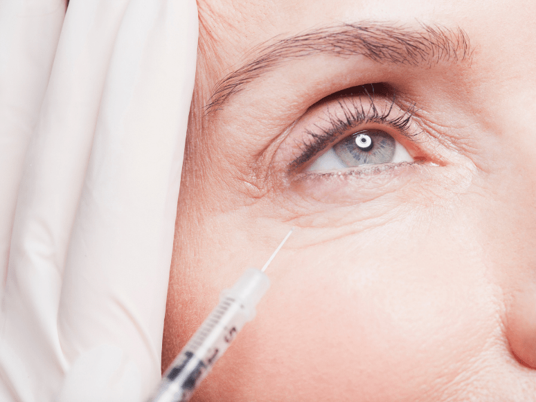 Mitos y verdades sobre el Bótox