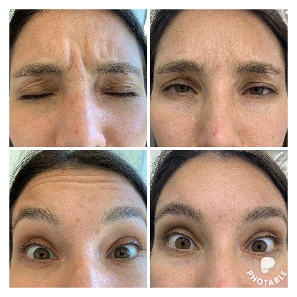 Mitos y verdades sobre el Bótox