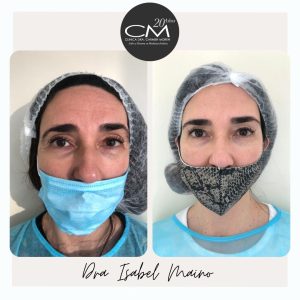 Corrección de ojeras Clínica Dra. Carmen Moren