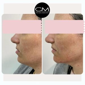Contorno mandibular Clínica Dra. Carmen Moren