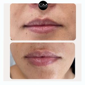 Embellecimiento labial Clínica Dra. Carmen Moren