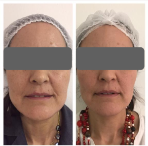 Bichectomía Clínica Dra. Carmen Moren