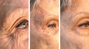 Plasmage Clínica Carmen Moren