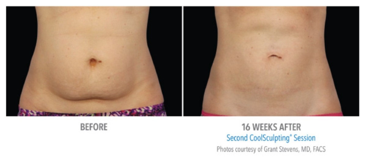 coolsculpting